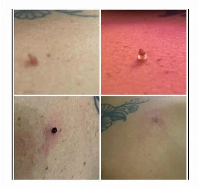 SKIN TAG - KILLER KIT
