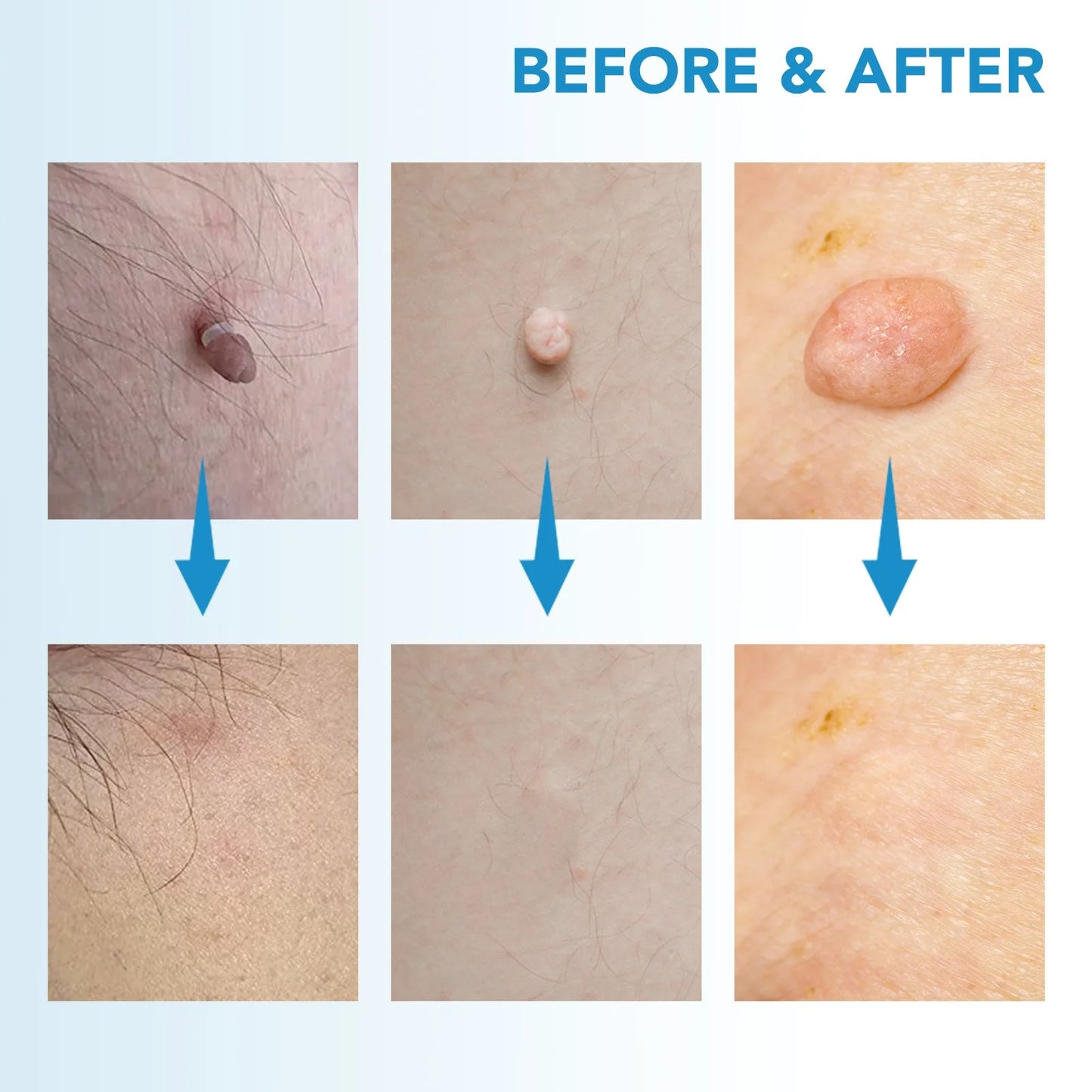 SKIN TAG - KILLER KIT