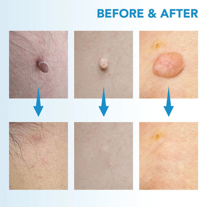 SKIN TAG - KILLER KIT