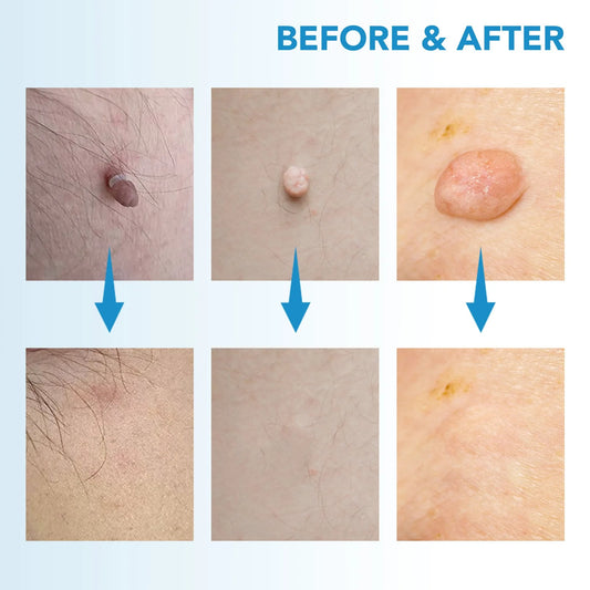 SKIN TAG - KILLER KIT